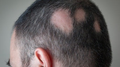 Stress-Related Hair Loss Conditions and Their Signs