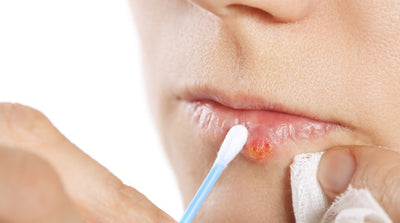 Treat Cold Sores This Winter Without a Prescription