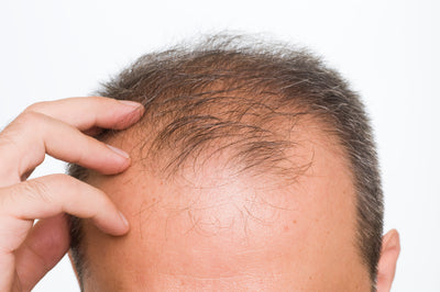 The Differences Between Men's and Women's Hair Loss